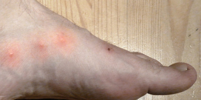 Propolis na bradavice a kuří oka